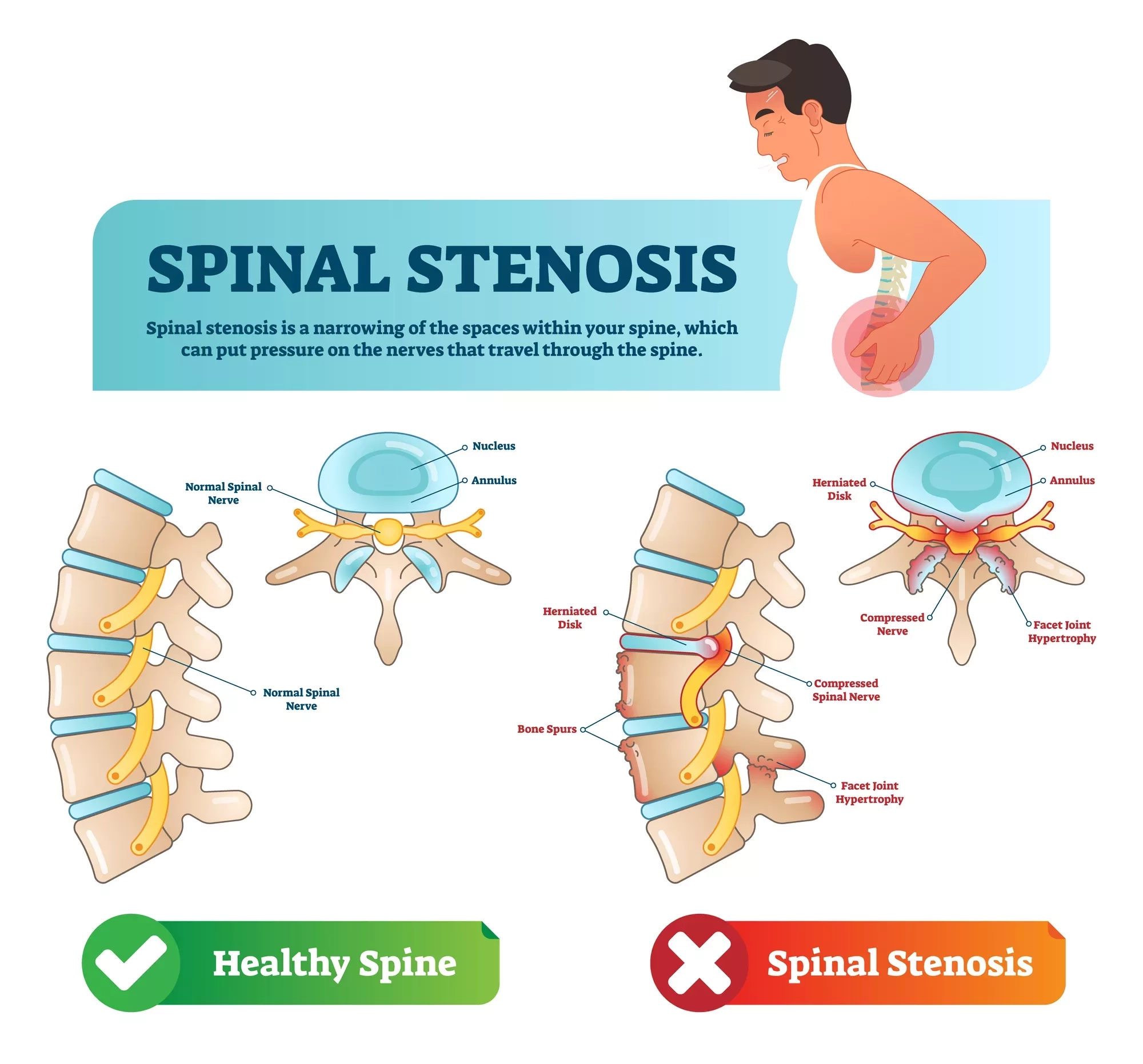 What Are The Final Stages Of Spinal Stenosis Premia Spine